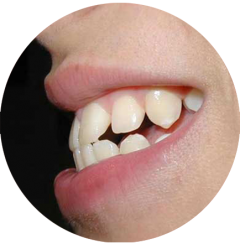 dientes desalineados leves