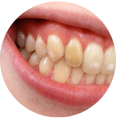 dientes manchados
