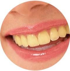 dientes amarillos
