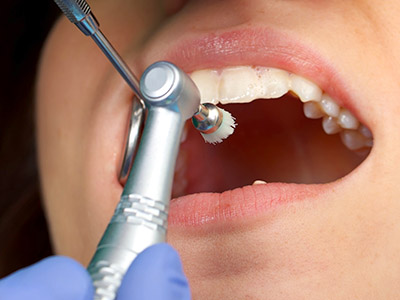 profilaxis dental