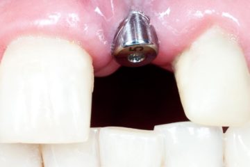 Implante dental atornillado