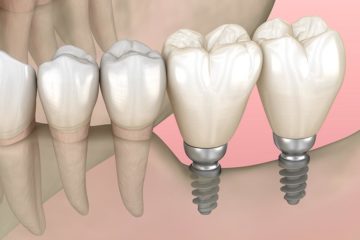mini implantes dentales