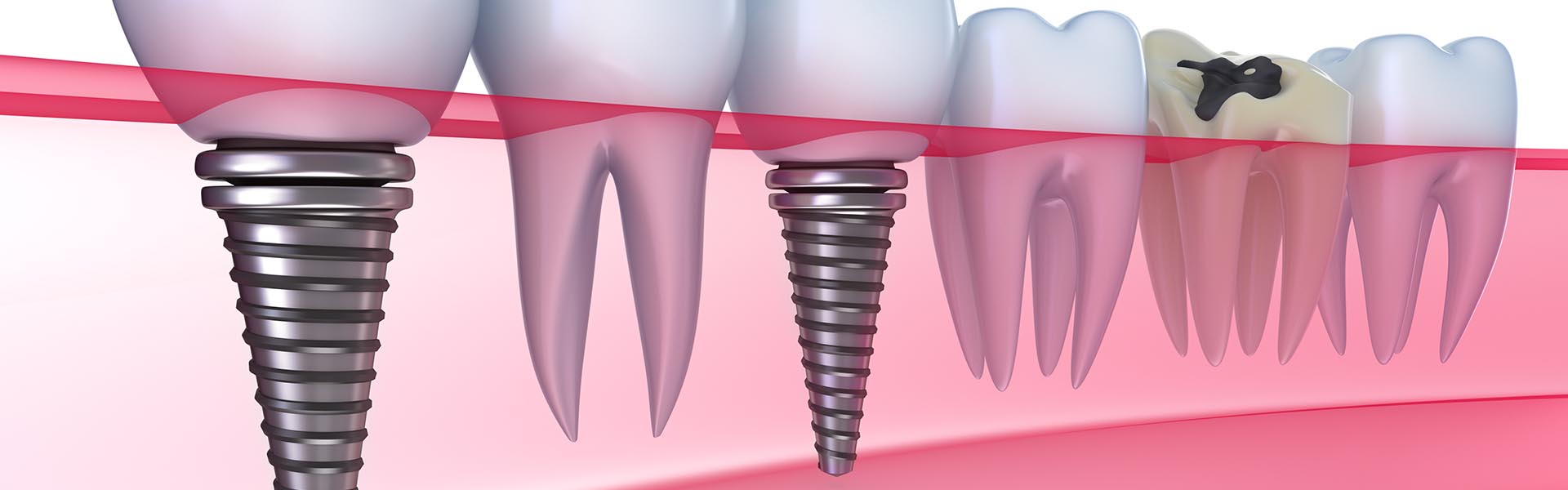 Tornillo para implante dental > Dra. Ana Maria Parra Odontóloga en