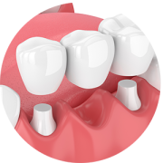 tratamiento de puente dental